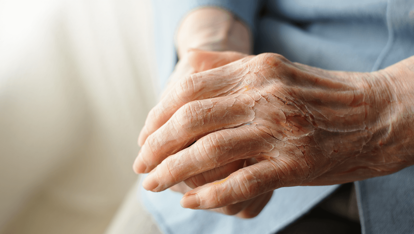 El daño solar, el uso de corticoides y el propio envejecimiento son las principales causas de la dermatoporosis